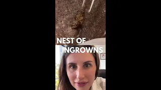 Huge Nest of Ingrown Hair