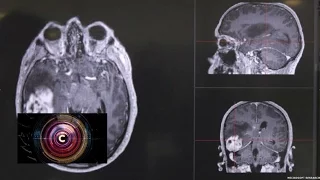 New scan aims to aid tumour detection - BBC Click