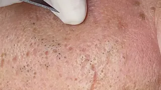 Old Age Blackheads Removal | Làm Sạch Mụn Đầu Đen Cho Khách Hàng Tuổi U60 -  SacDepSpa#236