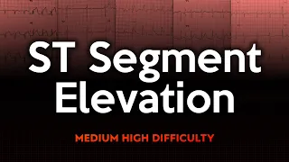 ST-Segment Elevation ECG Quiz: Medium to High Difficulty