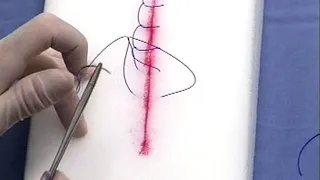 LES SUTURES CUTANÉES FMPM