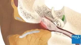 How glue ear develops