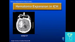 Intracerebral Hemorrhage   Part 1 | Health4TheWorld Academy