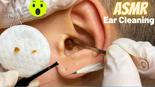 ASMR-Worlds’s Greatest Ear Cleaning on real person/Ear wax Removal/Binaural Sound w/Mika(No Talking)