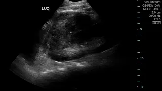 FAST Exam to Diagnose Subcapsular Renal Hematoma. JETem 2019