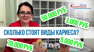 Виды кариеса и сколько стоит лечение |