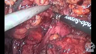 Laparoscopic Spleen Preserving Distal Subtotal Pancreatectomy with Lymph Node Dissection