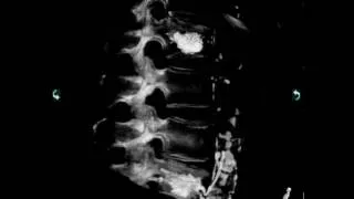 3-D image of Kyphoplasty