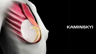 Anatomical implants under the muscle / KAMINSKYI