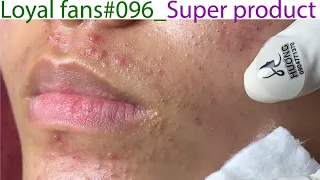Acne Treatment Huong Da Nang# 096 |  Loyal fans _ Super product