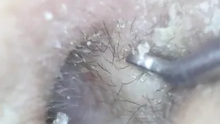 QUICK SELF EAR CLEANING- 28JUL2020