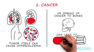 Endocrinology – Hypercalcemia: By Loree Boyle M.D.