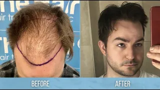 Simon's hair transplant journey and comb-through on wet hair