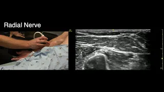 Identifying the Radial Nerve for POCUS Guided Regional Anesthesia
