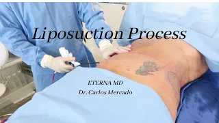 Liposuction | Eterna MD Medical Rejuvenation Center | Orlando, FL