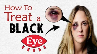 How to Treat a Black Eye Fast & Safely | Home Remedies for Black Eye Treatment