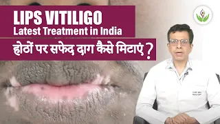 Lips Vitiligo Latest Treatment in India | होठों पर सफेद दाग कैसे मिटाएं? | Care Well Medical Centre