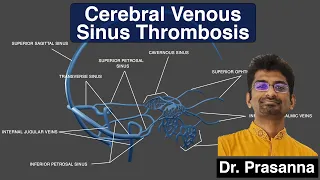 Cerebral Venous and Dural Sinus Thrombosis (CVST)