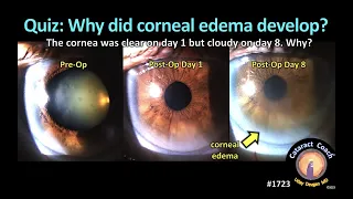 CataractCoach™1723: Quiz - Why did corneal edema develop?