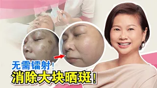 无需镭射，像5分钱那么大的日晒斑也能消除的祛斑护理！| Shakura, the Pigmentation Expert from Japan