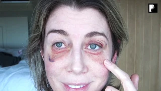 Blepharoplasty Video Diary - 2 Weeks After Surgery (10 of 15)