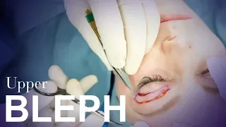 Upper Eyelid Blepharoplasty