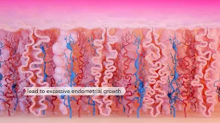 Menorrhagia, Heavy Periods | Medical Animation