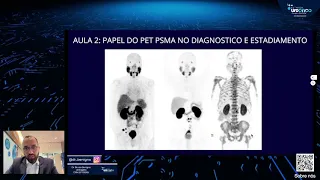 Texas - AUA 24 | Câncer de Próstata | A Ressonância magnética e o PET com PSMA avançam o Tratamento.