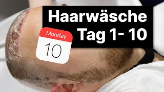 Haare waschen nach der Haartransplantation | Dr. Dogruer & Jacob M (Haarwäsche Tag 1 bis Tag 10)