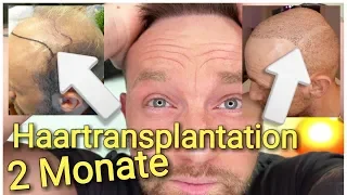 ZWEITE Haartransplantation Türkei 2 Monate Bartgrafts wachsen😲