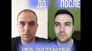 5 месяц после пересадки волос. Отчет на 165 день по пересадки волос Турции Стамбул 2020 год