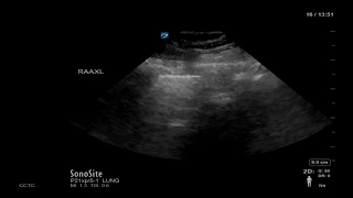 Lung Ultrasound Image Interpretation