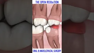 WISDOM TOOTH REMOVAL ANIMATION