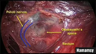 #Hamamsy #Laparoscopy #Roboticsurgery Anatomy of pelvic spaces