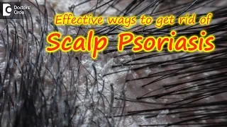Scalp psoriasis:Symptom, Cause, Treatment | Safe ways to Wash Hair -Dr. Rasya Dixit| Doctors' Circle