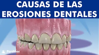 Abfracción, atrición, abrasión, reabsorción dental y otros problemas de desgaste de los dientes ©