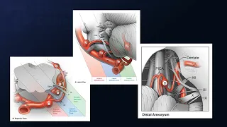 Suboccipital Craniotomy for Clipping of Ruptured Distal PICA Aneurysms