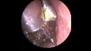 821 - Severely Squashed Ear Wax Removal