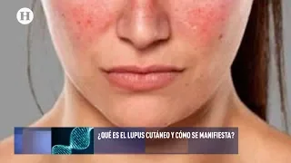 ¿Qué es y cómo se manifiesta el lupus cutáneo?