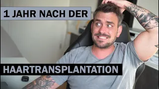 1 Jahr nach der 2. Haartransplantation | Grund, Dauer & Privatleben