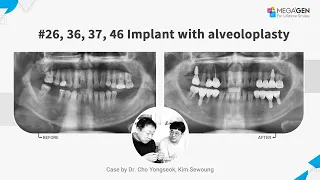 Dr. Yongseok CHO, Sewoung KIM, #26,36,37,46 implant with alveoloplasty