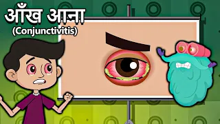 आँख आना | कंजंक्टिवाइटिस | What Causes Conjunctivitis In Hindi | Dr.Bincos Show | Educational Videos