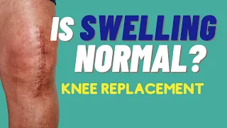 3 Tips To Reduce Swelling + What Is Normal Swelling And What Is Not: Knee Replacement