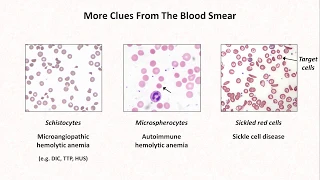 Anemia: Lesson 4 - Clues from the blood smear