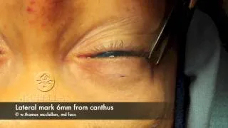 Live Surgery: Upper Blepharoplasty (Eyelid Lift) Part 1: Markings and Anesthesia