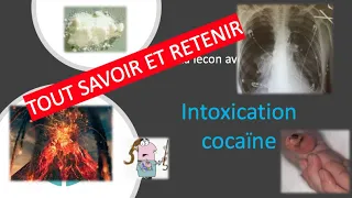 Urgences - la lecon avec cedille - Intoxication cocaïne