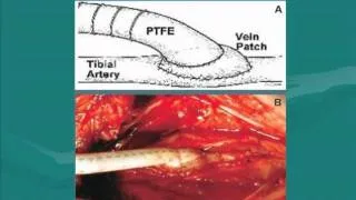 Surgical Approaches for Peripheral Arterial Disease (PAD)