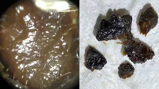 177 - Massive Haul of Ear Wax Removed using the WAXscope®️