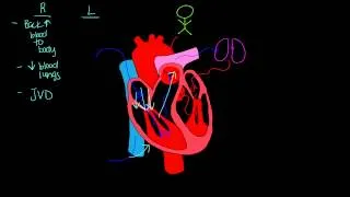 Left sided vs. Right sided heart failure