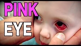 PINK EYE: Live Diagnosis (Conjunctivitis) | Dr. Paul